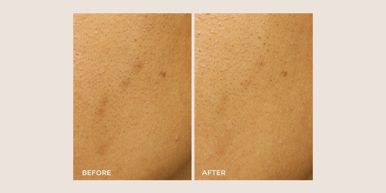 Before and after using product to minimize whiteheads